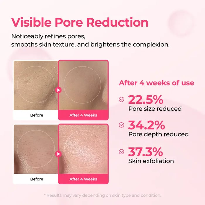 PoreTect Duo - Resurface Your Skin, Erase Imperfections - 50% OFF