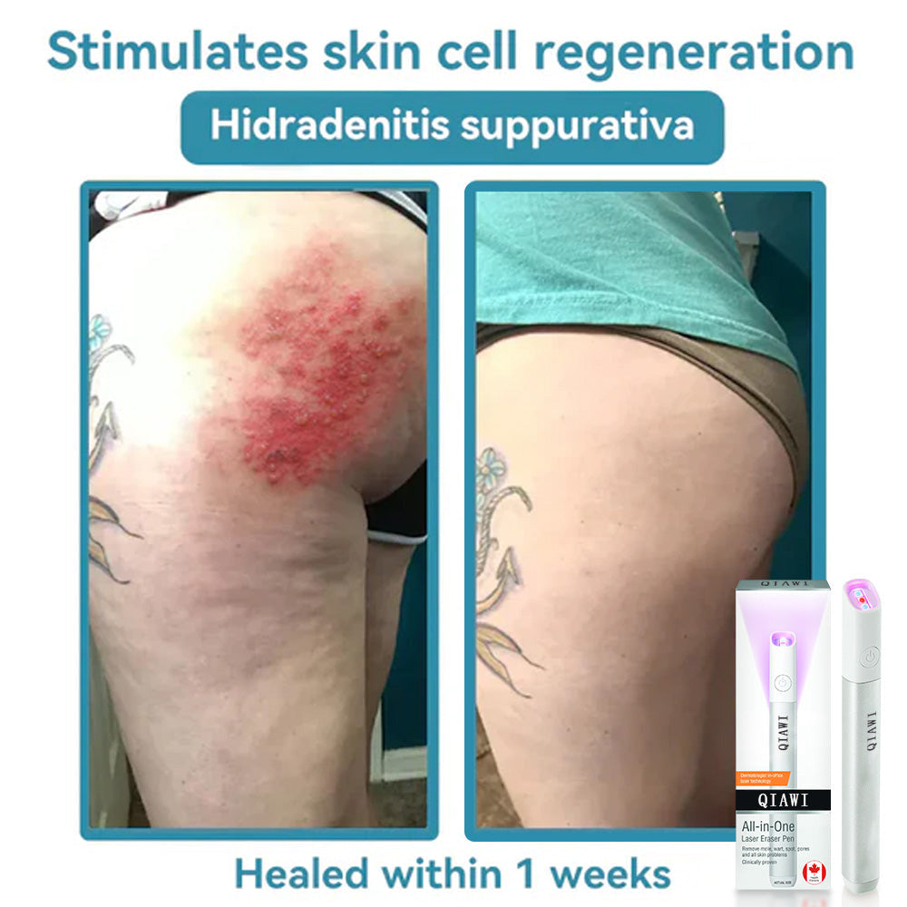 DermaClear Pen - Flawless Skin at Home - 50% OFF