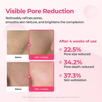 PoreTect Duo - Resurface Your Skin, Erase Imperfections - 50% OFF