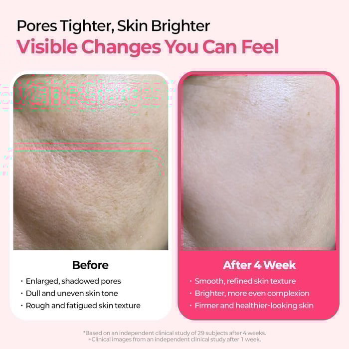 PoreTect Duo - Resurface Your Skin, Erase Imperfections - 50% OFF