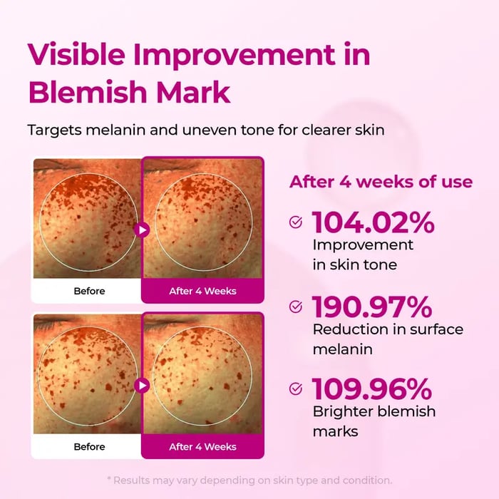 PoreTect Duo - Resurface Your Skin, Erase Imperfections - 50% OFF