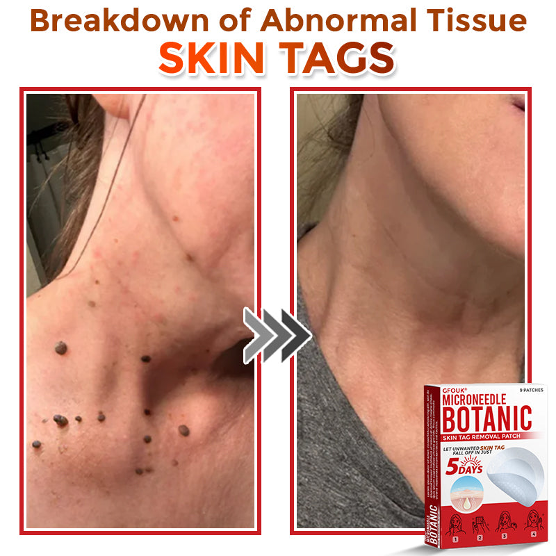 The AuraClear Skin Tag Patch - Botanic MicroNeedle Removal, Visible Results + 50% OFF