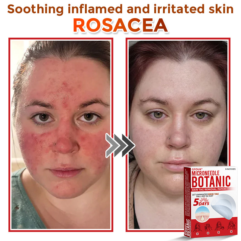 The AuraClear Skin Tag Patch - Botanic MicroNeedle Removal, Visible Results + 50% OFF