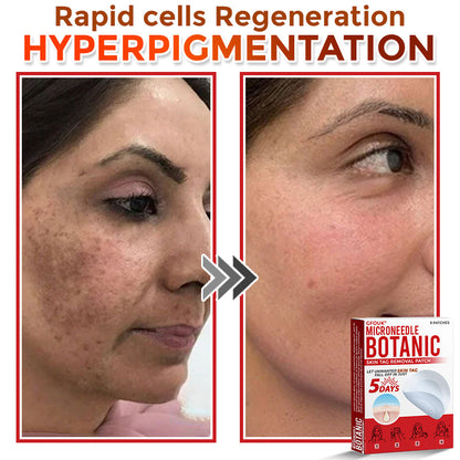 The AuraClear Skin Tag Patch - Botanic MicroNeedle Removal, Visible Results + 50% OFF