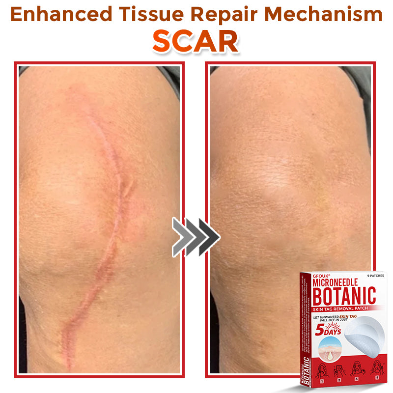 The AuraClear Skin Tag Patch - Botanic MicroNeedle Removal, Visible Results + 50% OFF