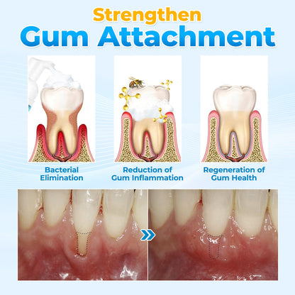 The MicroSmile Gum Restoration Kit - Bee Venom Mousse, Tongue Scraper, and FDA-Approved Healing + 50% OFF