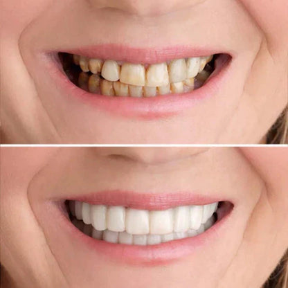 PerfectSmile Veneers - Get Your Dream Smile Instantly + 50% OFF