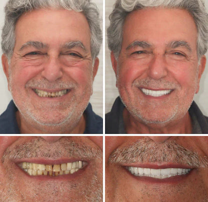 NaturaFit Dentures - The No-Slip, Custom-Fit Smile + 50% OFF