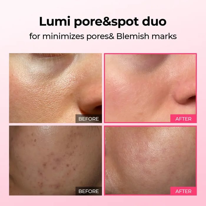 PoreTect Duo - Resurface Your Skin, Erase Imperfections - 50% OFF