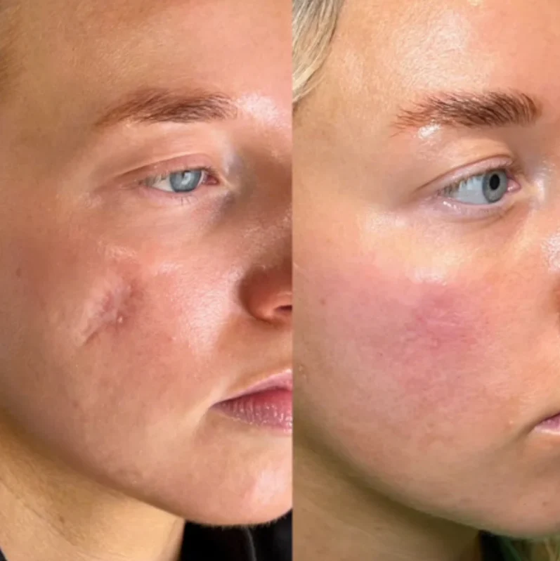 The AuraScar Silicone ScarStick - Advanced Scar Reduction, Portable Stick, and  Happy Customers + 50% OFF